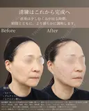 50代 | フェイスライン改善リフト before画像 サムネイル用