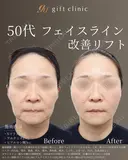 50代 | フェイスライン改善リフト after画像 サムネイル用