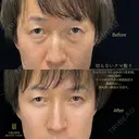 切らないクマ取り before画像 サムネイル用
