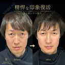 切らないクマ取り 30日後 サムネイル用