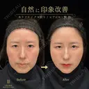 小顔輪郭整形・クマ治療 30日後 サムネイル用