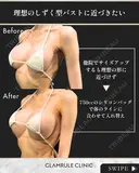 シリコンバッグ豊胸(他院修正) before画像 サムネイル用