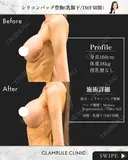 シリコンバッグ豊胸(他院修正) after画像 サムネイル用