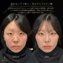 切らないクマ取り before画像 サムネイル用