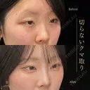 切らないクマ取り 30日後 サムネイル用