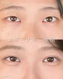 エターナル二重術 30日後 サムネイル用