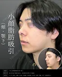 【脂肪吸引】顎下＋頬 before画像 サムネイル用