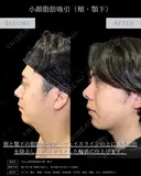 【脂肪吸引】顎下＋頬 after画像 サムネイル用