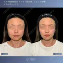 すっきりフェイスラインへ⭐︎顔脂肪吸引×エラボトックス 30日後 サムネイル用