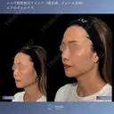 すっきりフェイスラインへ⭐︎顔脂肪吸引×エラボトックス 30日後 サムネイル用