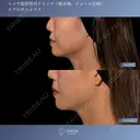 すっきりフェイスラインへ⭐︎顔脂肪吸引×エラボトックス 30日後 サムネイル用