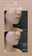 【顎】ヒアルロン酸注入 before画像 サムネイル用