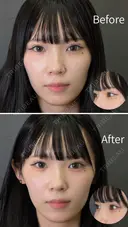 【涙袋】ヒアルロン酸注入 before画像 サムネイル用