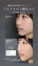 【リップ】ヒアルロン酸注入 after画像 サムネイル用