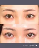 二重埋没 before画像 サムネイル用