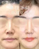 鼻柱下降（単独症例） after画像 サムネイル用