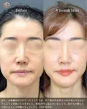 鼻柱下降（単独症例） before画像 サムネイル用