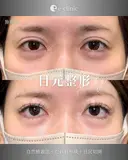 目元整形（拡大） after画像 サムネイル用