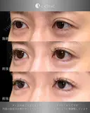 目元整形（拡大） before画像 サムネイル用