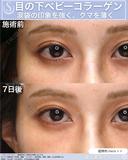 【20代女性】目の下のクマを薄く：ベビーコラーゲン 7日後 サムネイル用