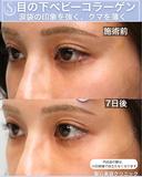 【20代女性】目の下のクマを薄く：ベビーコラーゲン 7日後 サムネイル用