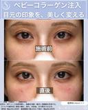【20代女性】目の下のクマを薄く：ベビーコラーゲン before画像 サムネイル用