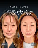 岩﨑先生による🐻クマ取り🐻 before画像 サムネイル用