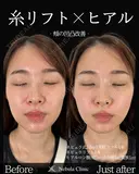 Dr岩切👑小顔整形👑 before画像 サムネイル用