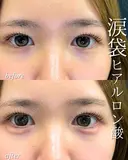 涙袋ヒアルロン酸 before画像 サムネイル用
