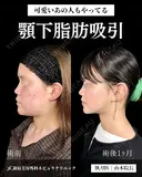 山本による🎀脂肪吸引🎀 before画像 サムネイル用