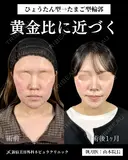 山本による🎀脂肪吸引🎀 30日後 サムネイル用