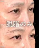 山本による【クマ治療】 7日後 サムネイル用