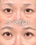 山本による【クマ治療】 before画像 サムネイル用