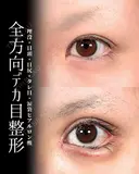 デカ目整形 before画像 サムネイル用