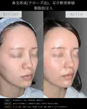 【鼻整形】鼻尖形成クローズ法＋耳介軟骨移植＋鼻柱下降＋額脂肪注入 before画像 サムネイル用