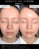 【鼻整形】鼻尖形成クローズ法＋耳介軟骨移植＋鼻柱下降＋額脂肪注入 after画像 サムネイル用