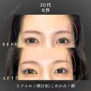 ヒアルロン酸注入/こめかみ after画像 サムネイル用