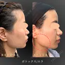 エラボトックス after画像 サムネイル用