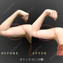 二の腕ボトックス 60日後 サムネイル用