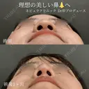 理想の忘れ鼻に✨ 30日後 サムネイル用