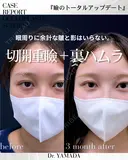 【二重切開＆裏ハムラ】目周りをトータルで整える 90日後 サムネイル用