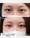 【二重切開＆裏ハムラ】目周りをトータルで整える 90日後 サムネイル用