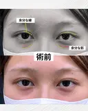 【二重切開＆裏ハムラ】目周りをトータルで整える before画像 サムネイル用