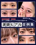 【涙袋ヒアルロン酸】大人気メニュー before画像 サムネイル用