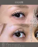 目尻切開 before画像 サムネイル用