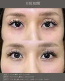 目尻切開 after画像 サムネイル用