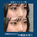 涙袋　ヒアルロン酸（ボルベラ） before画像 サムネイル用