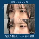 涙袋　ヒアルロン酸（ボルベラ） after画像 サムネイル用