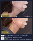 【女性・首もとを深層から整える】ネックリフト＋ペリカン手術（3ヶ月） before画像 サムネイル用