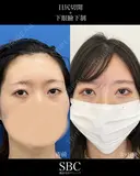 目尻切開・下眼瞼下制 before画像 サムネイル用